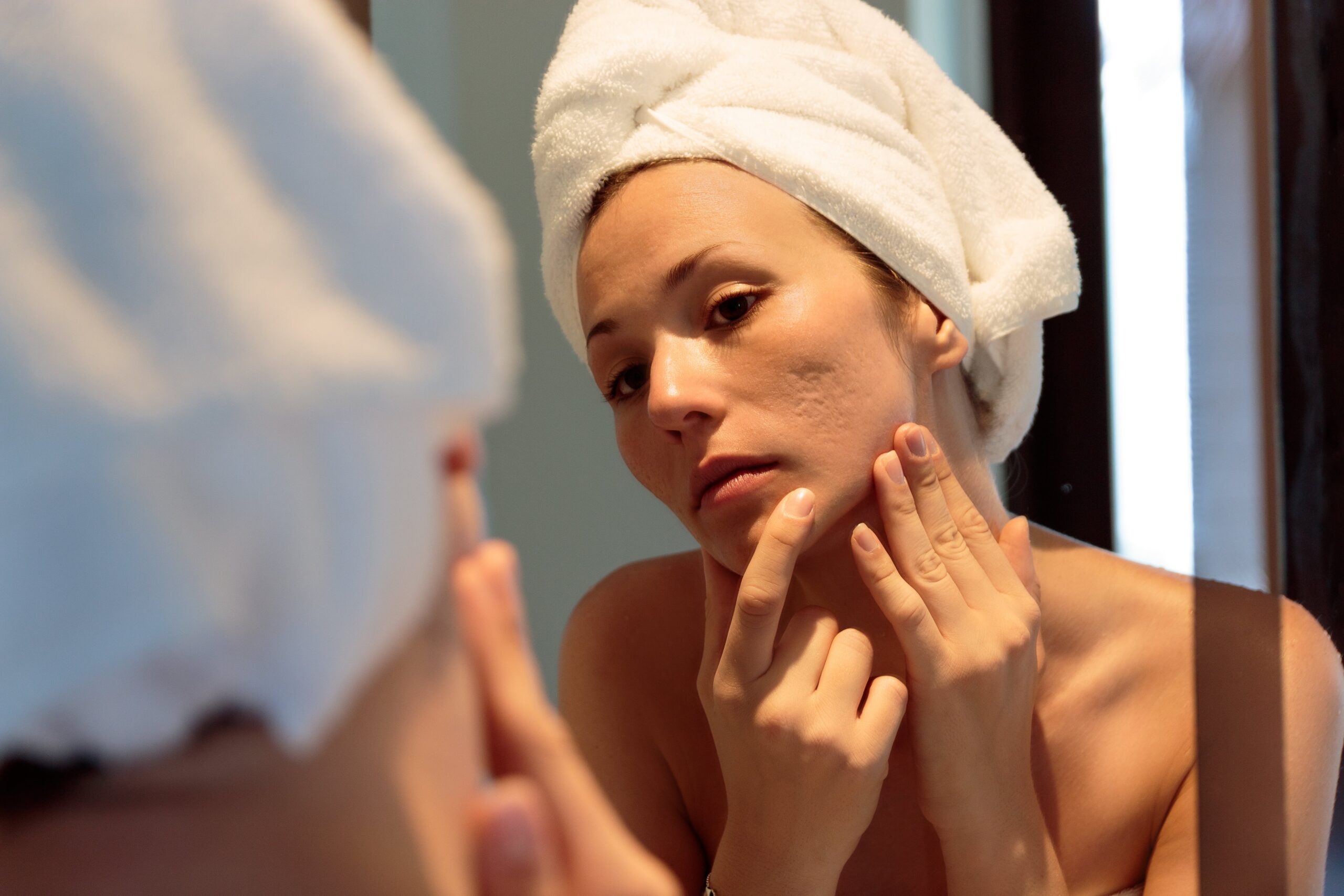 Acne Scar Treatment