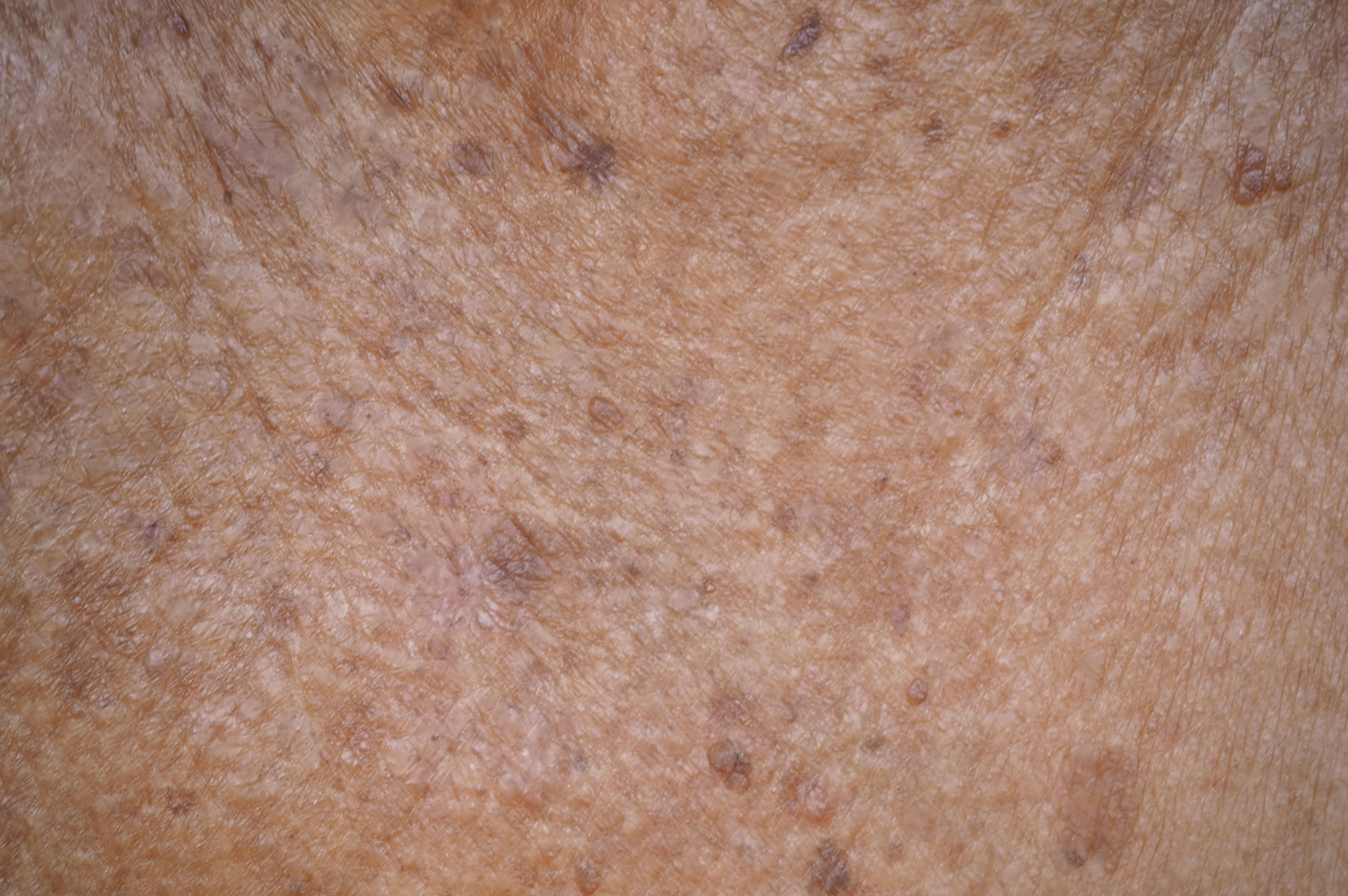 Actinic Keratosis