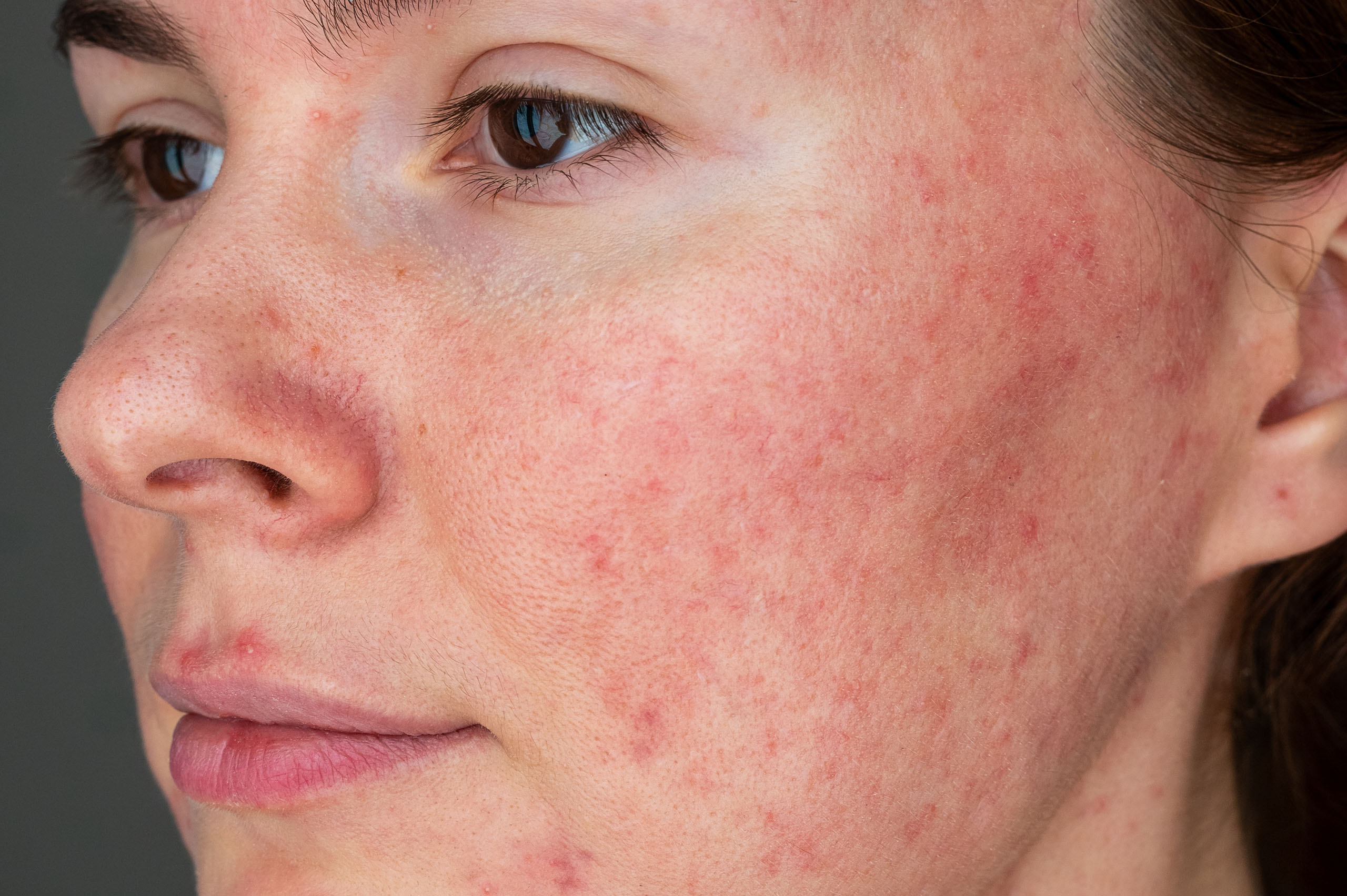 Rosacea