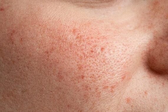 What to Do About Enlarged Pores