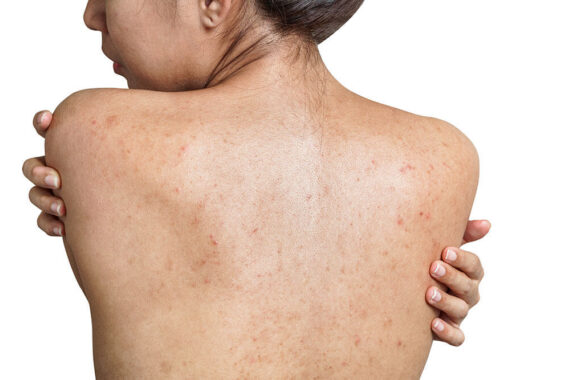 Treating Pityrosporum Folliculitis: What You Should Know