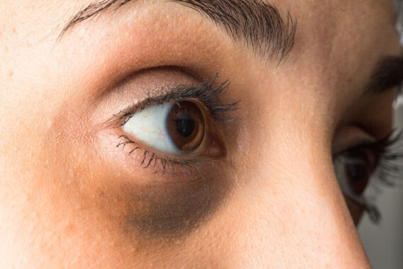 Eye of the Beholder: 3 Ways to Get Rid of Dark Circles