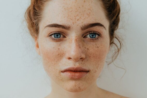 Can You Really Get Rid of Freckles?