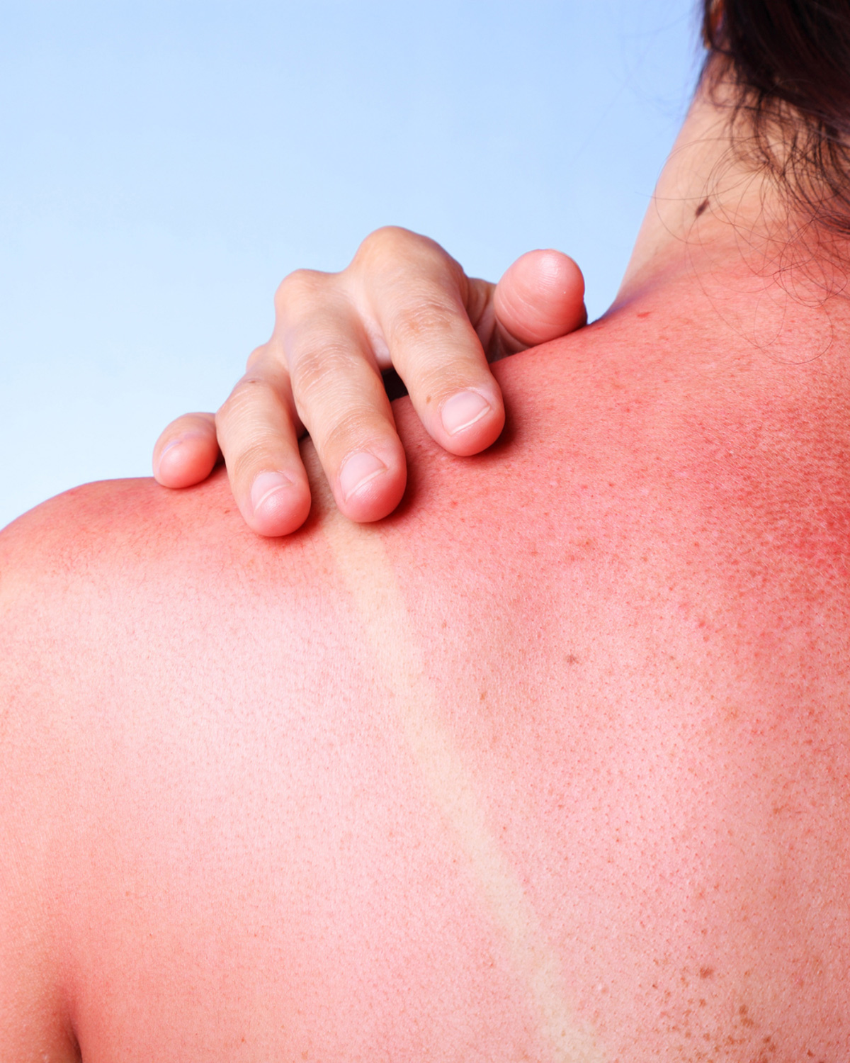 How to Choose the Right Sunscreen for Your Skin Type