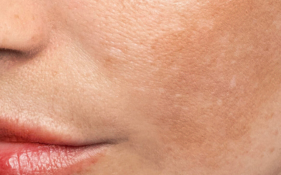 Melasma vs. Sun Spots vs. Age Spots: How to Tell Them Apart